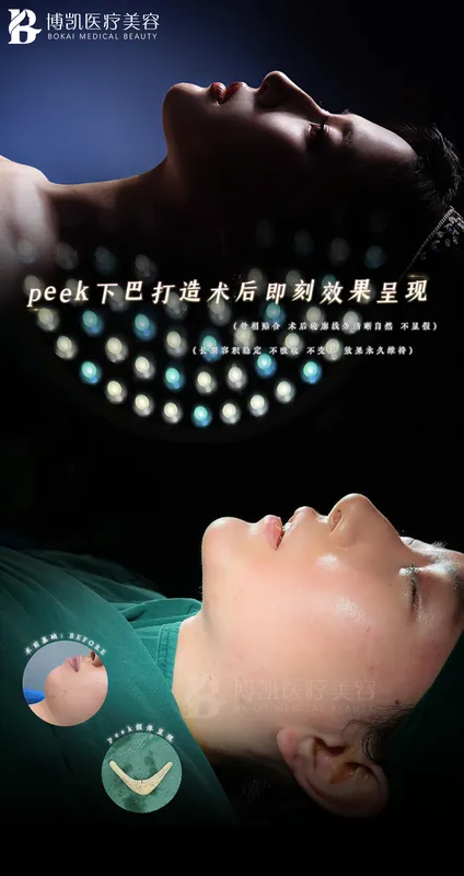 PEEK 下巴假体案例 · BOKAI