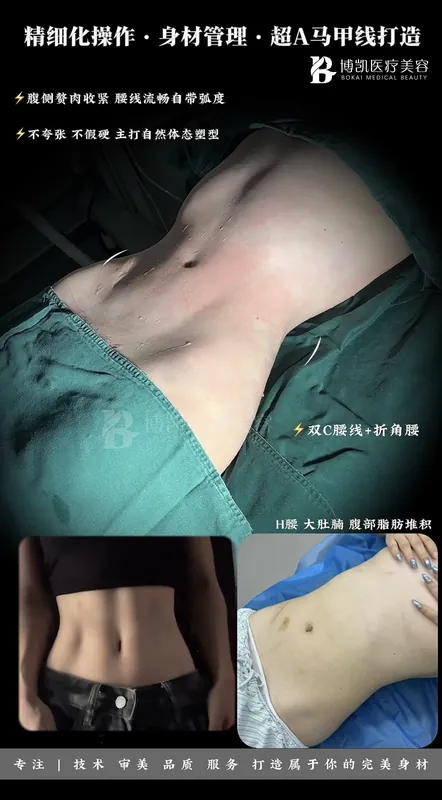 腰腹塑形案例 · BOKAI