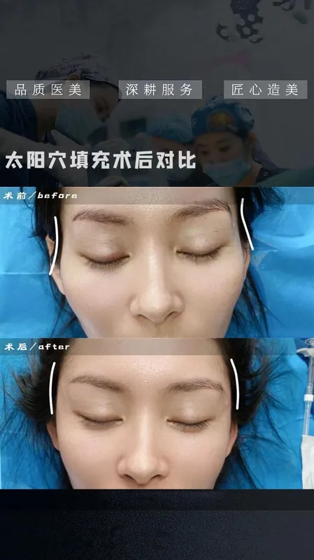 太阳穴填充案例 · BOKAI
