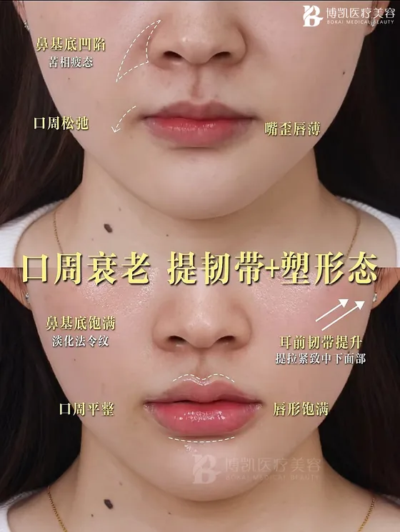口周与唇形调整 · BOKAI