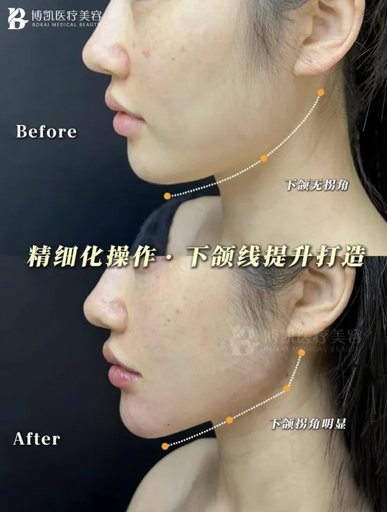 下颌线轮廓调整 · BOKAI