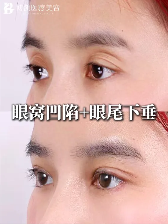眼窝与眼尾对比 · BOKAI