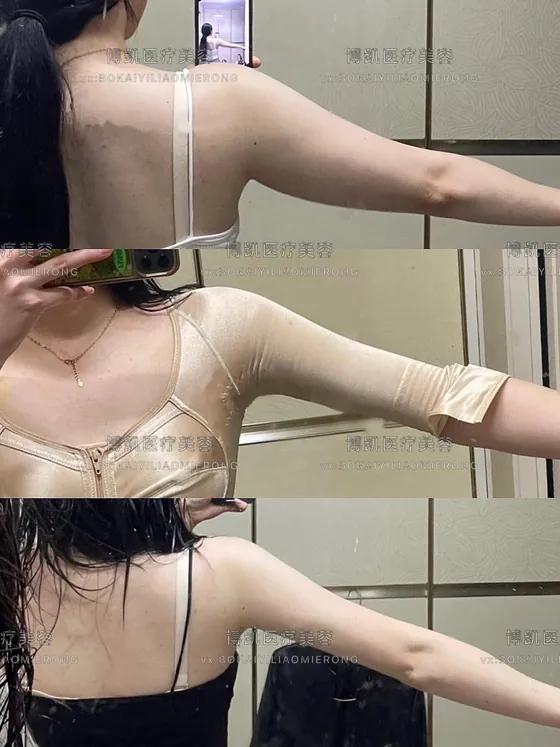 手臂轮廓恢复记录 · BOKAI
