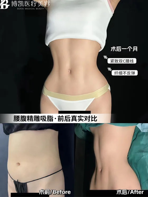 腰腹吸脂 · 一个月记录 · BOKAI